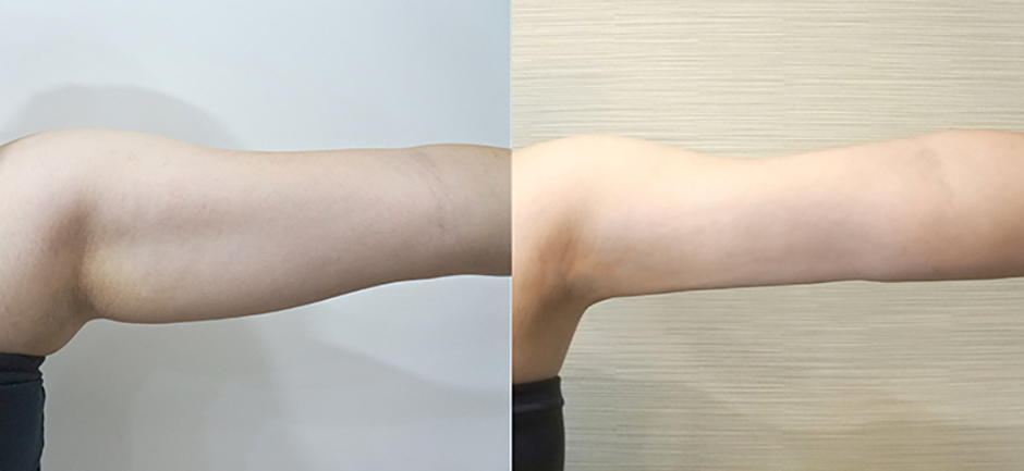 雷射減脂,楊氏羅丹,贅肉,瘦手臂